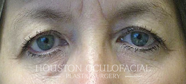 Upper Eyelid Blepharoplasty Results Houston
