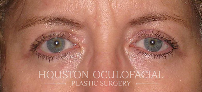 Upper Eyelid Blepharoplasty Results Houston