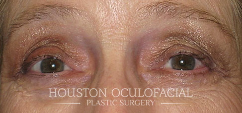 Eyelid Malpositions - After