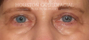 Eye of a person who has a droopy eyelids