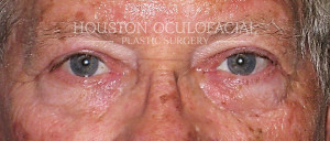 Functional Blepharoplasty Result Houston
