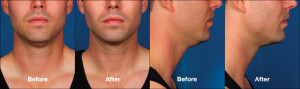 Kybella Result Houston
