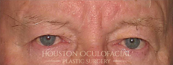 Upper Eyelid Blepharoplasty