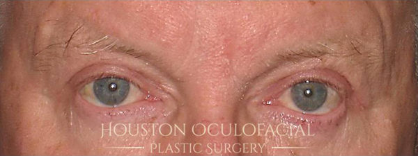 Upper Eyelid Blepharoplasty