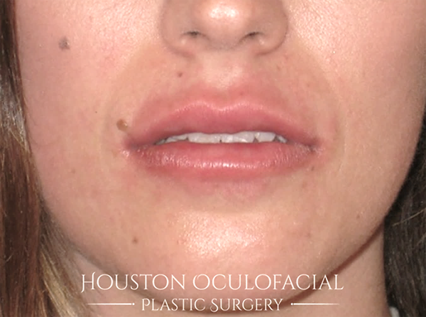 Lip Augmentation Case 4550 After Photo Lip Augmentation