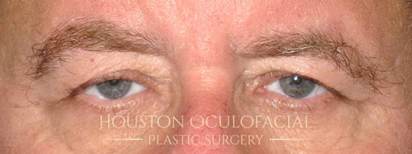 Upper Eyelid Blepharoplasty