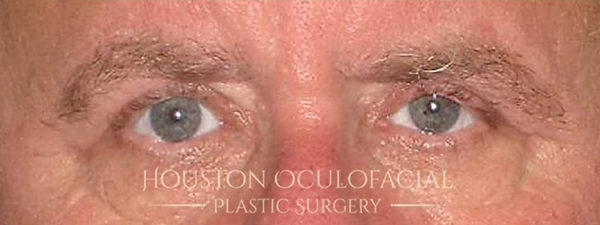 Upper Eyelid Blepharoplasty