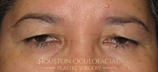 Upper Eyelid Blepharoplasty