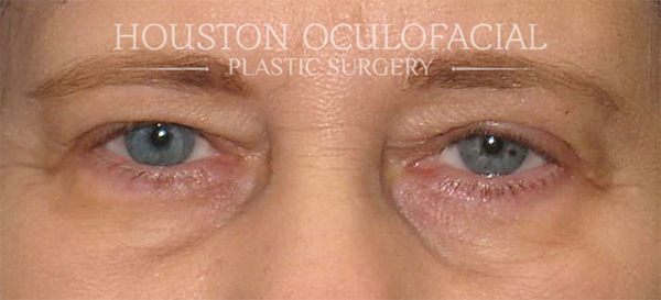 Upper Eyelid Blepharoplasty