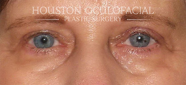 Upper Eyelid Blepharoplasty