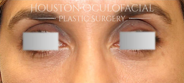 Botox ® Injections