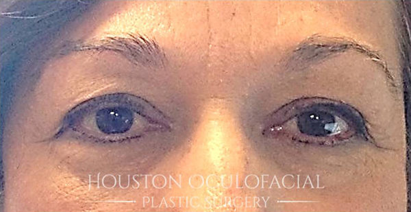 Upper Eyelid Blepharoplasty