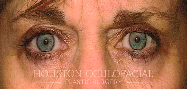 Ptosis (Droopy Eyelid) Repair