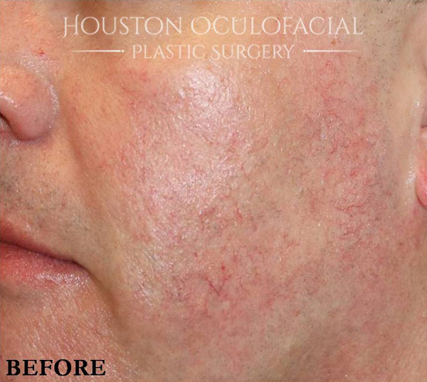 IPL (PhotoRejuvenation) Case 4606 Before Photo IPL (PhotoRejuvenation)