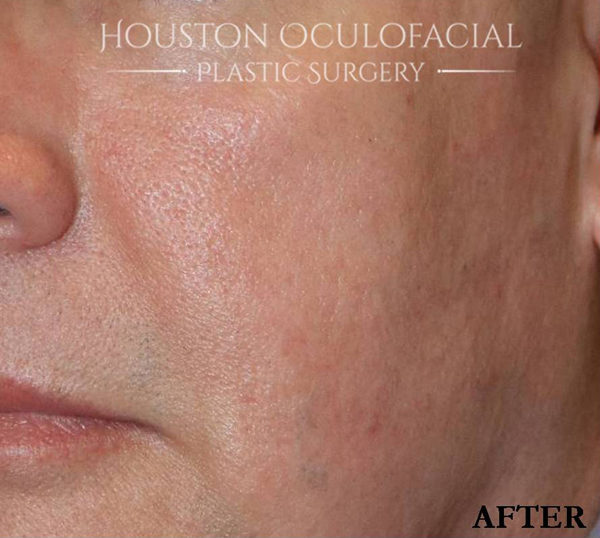 IPL (PhotoRejuvenation) Case 4606 After Photo IPL (PhotoRejuvenation)