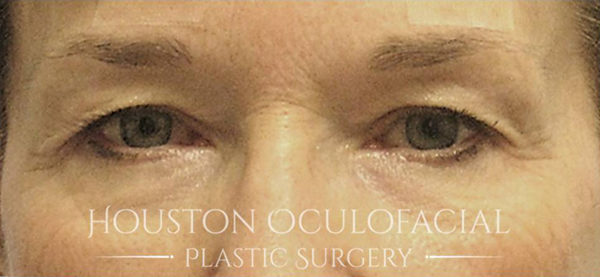 Upper Eyelid Blepharoplasty