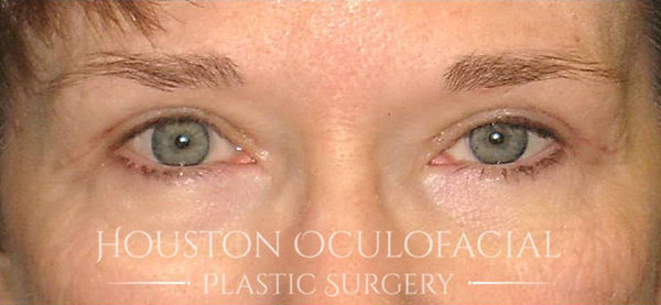 Upper Eyelid Blepharoplasty