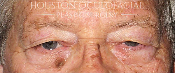 Upper Eyelid Blepharoplasty Case 4628 Before Photo Upper Eyelid Blepharoplasty