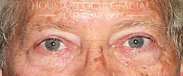 Upper Eyelid Blepharoplasty