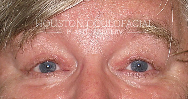 Ptosis (Droopy Eyelid) Repair