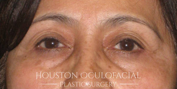 Ptosis (Droopy Eyelid) Repair Case 4634 After Photo Ptosis (Droopy Eyelid) Repair