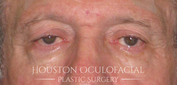 Upper Eyelid Blepharoplasty