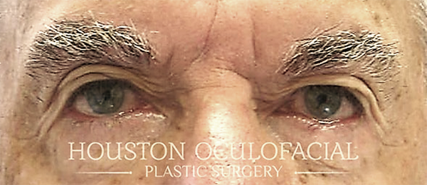 Upper Eyelid Blepharoplasty