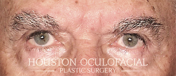 Upper Eyelid Blepharoplasty