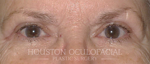 Upper Eyelid Blepharoplasty