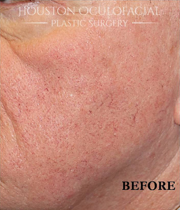IPL (PhotoRejuvenation) Case 4559 Before Photo IPL (PhotoRejuvenation)