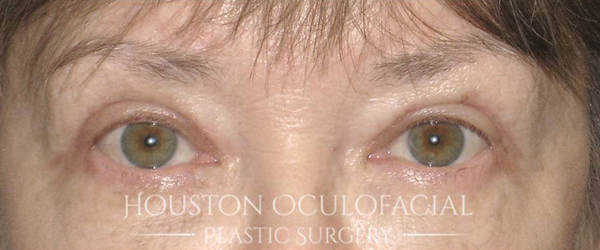 Upper Eyelid Blepharoplasty