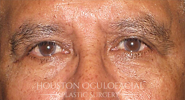 Upper Eyelid Blepharoplasty