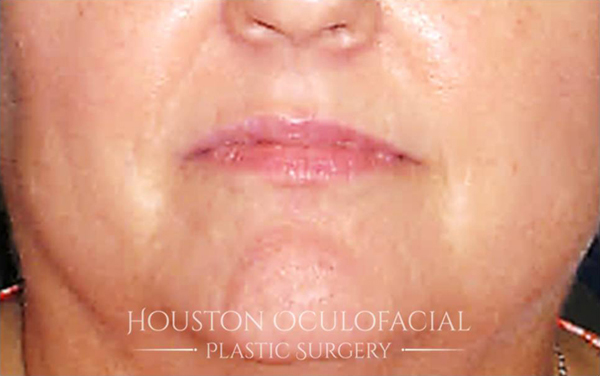 Lip Augmentation