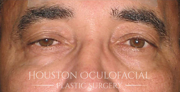 Upper Eyelid Blepharoplasty