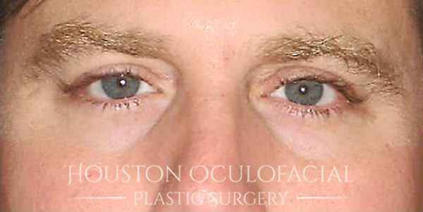 Upper Eyelid Blepharoplasty