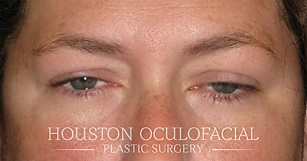 Upper Eyelid Blepharoplasty