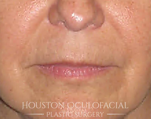 Lip Augmentation Case 4688 Before Photo Lip Augmentation