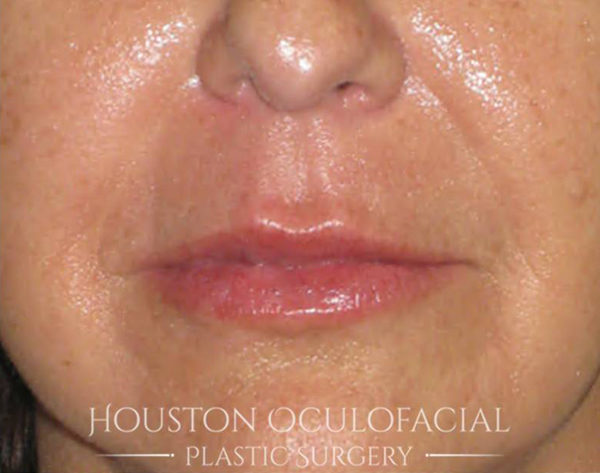 Lip Augmentation Case 4688 After Photo Lip Augmentation