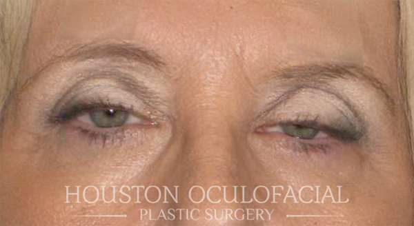 Ptosis (Droopy Eyelid) Repair Case 4691 Before Photo Ptosis (Droopy Eyelid) Repair