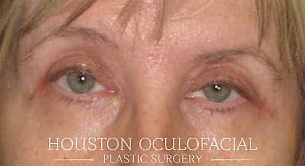 Ptosis (Droopy Eyelid) Repair Case 4691 After Photo Ptosis (Droopy Eyelid) Repair