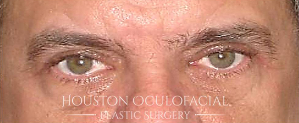 Ptosis (Droopy Eyelid) Repair