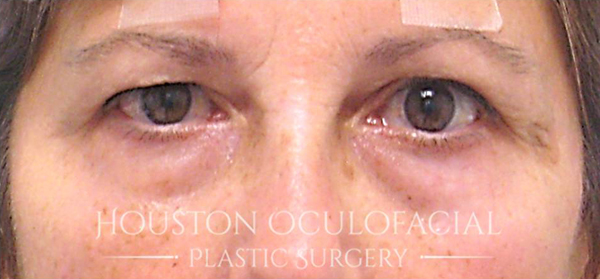 Upper Eyelid Blepharoplasty