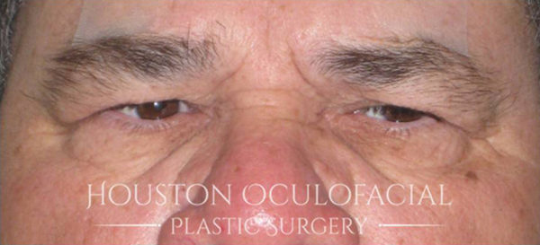 Upper Eyelid Blepharoplasty Case 4712 Before Photo Upper Eyelid Blepharoplasty