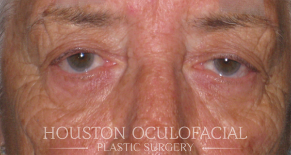 Upper Eyelid Blepharoplasty Case 4715 Before Photo Upper Eyelid Blepharoplasty