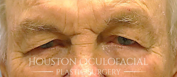 Upper Eyelid Blepharoplasty
