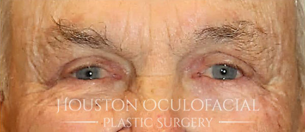 Upper Eyelid Blepharoplasty