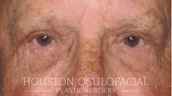 Upper Eyelid Blepharoplasty