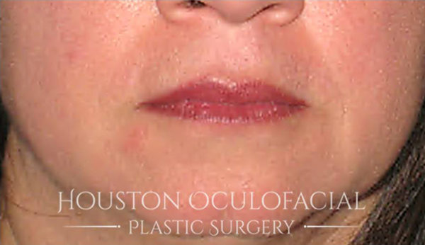 Lip Augmentation