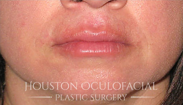 Lip Augmentation