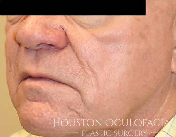 IPL (PhotoRejuvenation) Case 4559 After Photo IPL (PhotoRejuvenation)